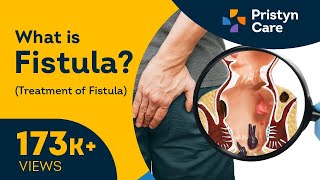 What is Fistula  Symptoms amp Treatment of Fistula [upl. by Grosvenor963]