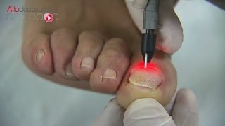 Mycoses des ongles  le traitement au laser  Allô Docteurs [upl. by Merrilee879]