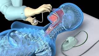 Nasotracheal suctioning NTS  3D animation [upl. by Danica]