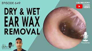 649  Dry amp Wet Ear Wax Removal [upl. by Odranar]