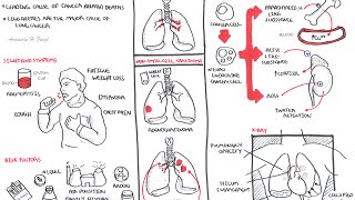 Lung Cancer  Overview [upl. by Ona161]