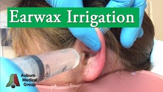 Ear Wax Irrigation  Auburn Medical Group [upl. by Naujit317]