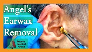 Angels Earwax Removal  Auburn Medical Group [upl. by Bina]