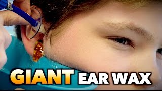 GIANT EAR WAX REMOVAL  Dr Paul [upl. by Ainniz]