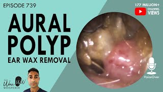 739  Infected Aural Polyp Ear Wax Removal [upl. by Klecka173]