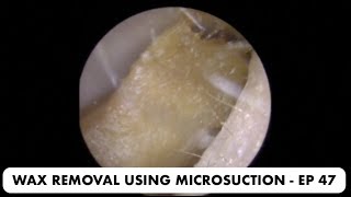 EAR WAX REMOVAL USING MICROSUCTION  EP 47 [upl. by Llirrem530]