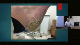 Itch in Elderly Skin  Dr Ian Bekker [upl. by Aislehc]