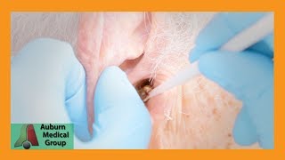 Chucks Tough Ear Wax Removal Part 1  Auburn Medical Group [upl. by Darlene]