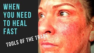 FULL FACE FIBROBLAST HEALING [upl. by Courcy]